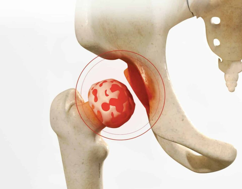 Chirurgie esthétique prothèse intermédiaire de hanche en Tunisie